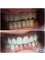 Hungary Dental Implant - Budapest - E.max veneers_before-after5 