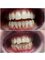 Hungary Dental Implant - Budapest - Zirconium-Ceramic crowns_before-after3 