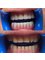 Hungary Dental Implant - Budapest - Zirconium-Ceramic crowns_before-after1 