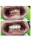 Hungary Dental Implant - Budapest - E.max veneers_before-after4 