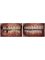 Hungary Dental Implant - Budapest - Dental implant treatment_before-after2 