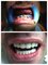Hungary Dental Implant - Budapest - Dental implant treatment_before-after4 