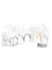 Veneer - full porcelain - e.max IPS - Save on Dental Care - Budapest