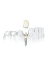 Implantatkörper (Zahnimplantat) - Save on Dental Care - Budapest