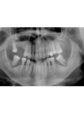 Panoramic Dental X-Ray - Save on Dental Care - Budapest
