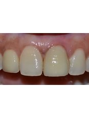 Dental Implants - Dr. Ajay Dental Clinic & Research Center