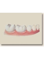 Dental Bridges - Dr. Ajay Dental Clinic & Research Center