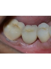 Restoration of Implants - Dr. Ajay Dental Clinic & Research Center