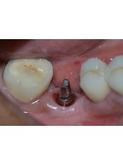 Restoration of Implants - Dr. Ajay Dental Clinic & Research Center