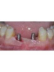 Implant Bridge - Dr. Ajay Dental Clinic & Research Center