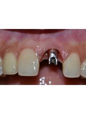 Dental Implants - Dr. Ajay Dental Clinic & Research Center