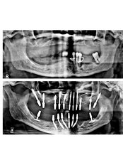 3 Days Implants - Relax Dental Spa