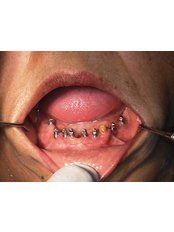 Dental Implants - Relax Dental Spa