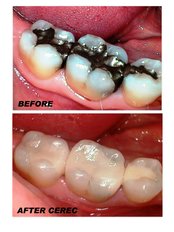White Cosmetic Fillings - Relax Dental Spa