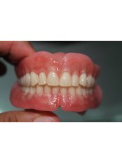 Full Dentures - Relax Dental Spa