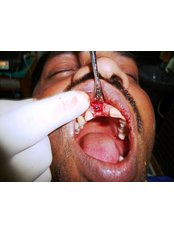 Immediate Implant Placement - Relax Dental Spa