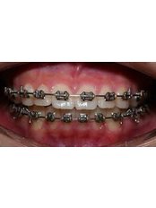 Accelerated Braces™ - Superspeciality Dental and Orthodontic Centre