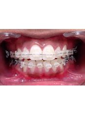 Ceramic Braces - Superspeciality Dental and Orthodontic Centre