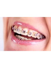 Adult Braces - Superspeciality Dental and Orthodontic Centre