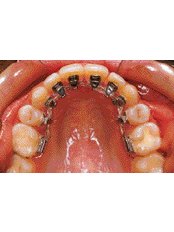 Lingual Braces - Superspeciality Dental and Orthodontic Centre