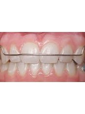 Orthodontic Retainer - Superspeciality Dental and Orthodontic Centre