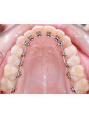 Orthodontist Consultation - BITES N BRACES