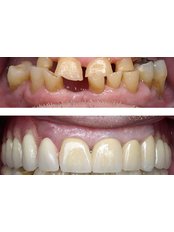 Full Mouth Rehabilitation - Dhwanil Dental Clinic