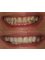 Jain Dental Hospital and Oral Health Care Centre - tooth venners for smile enhancement 