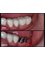 Jain Dental Hospital and Oral Health Care Centre - tooth implant for molers 