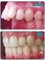 Jain Dental Hospital and Oral Health Care Centre -  teeth bedfore and after braces 