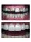 Jain Dental Hospital and Oral Health Care Centre - smile improvement by crowns 