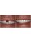 Jain Dental Hospital and Oral Health Care Centre -  replacement of missing teeths 