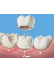 Dental Crowns - City Dental Centre Aurangabad