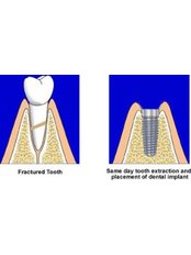 Immediate Implant Placement - City Dental Centre Aurangabad