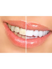 Teeth Whitening - City Dental Centre Aurangabad