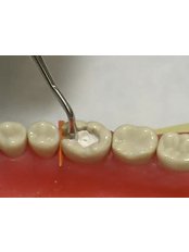 Temporary Filling - Arun Dental Clinic