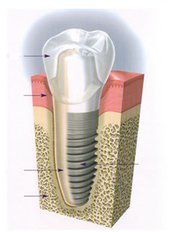 Dental Implants - Arun Dental Clinic