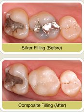 White Filling - Arun Dental Clinic