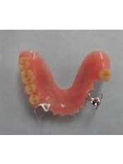 Removable Partial Dentures - Arun Dental Clinic
