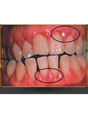 Gingival Flap Surgery - Bala Dental Clinic