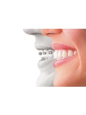 Clear Braces - Bala Dental Clinic