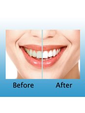 Teeth Whitening - Bala Dental Clinic