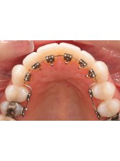 Lingual Braces - Bala Dental Clinic