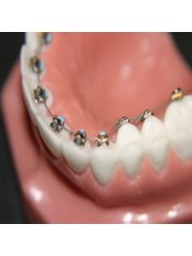 Braces - Bala Dental Clinic