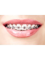 Metal Braces - Bala Dental Clinic