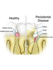 Periodontitis Treatment - Bala Dental Clinic