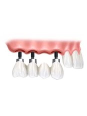 Dental Implants - Bala Dental Clinic
