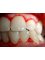 Bala Dental Clinic - bleeding gum 