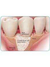 Bone Graft  - Bala Dental Clinic