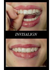Gum Contouring and Reshaping - Bala Dental Clinic